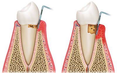 The PSR, CPITN and IARTI: The Initial Assessment and
Ranking of Periodontal
Treatment Index an Improved
Rapid Classifying Index of
Periodontal and
Perio-Restorative Cases