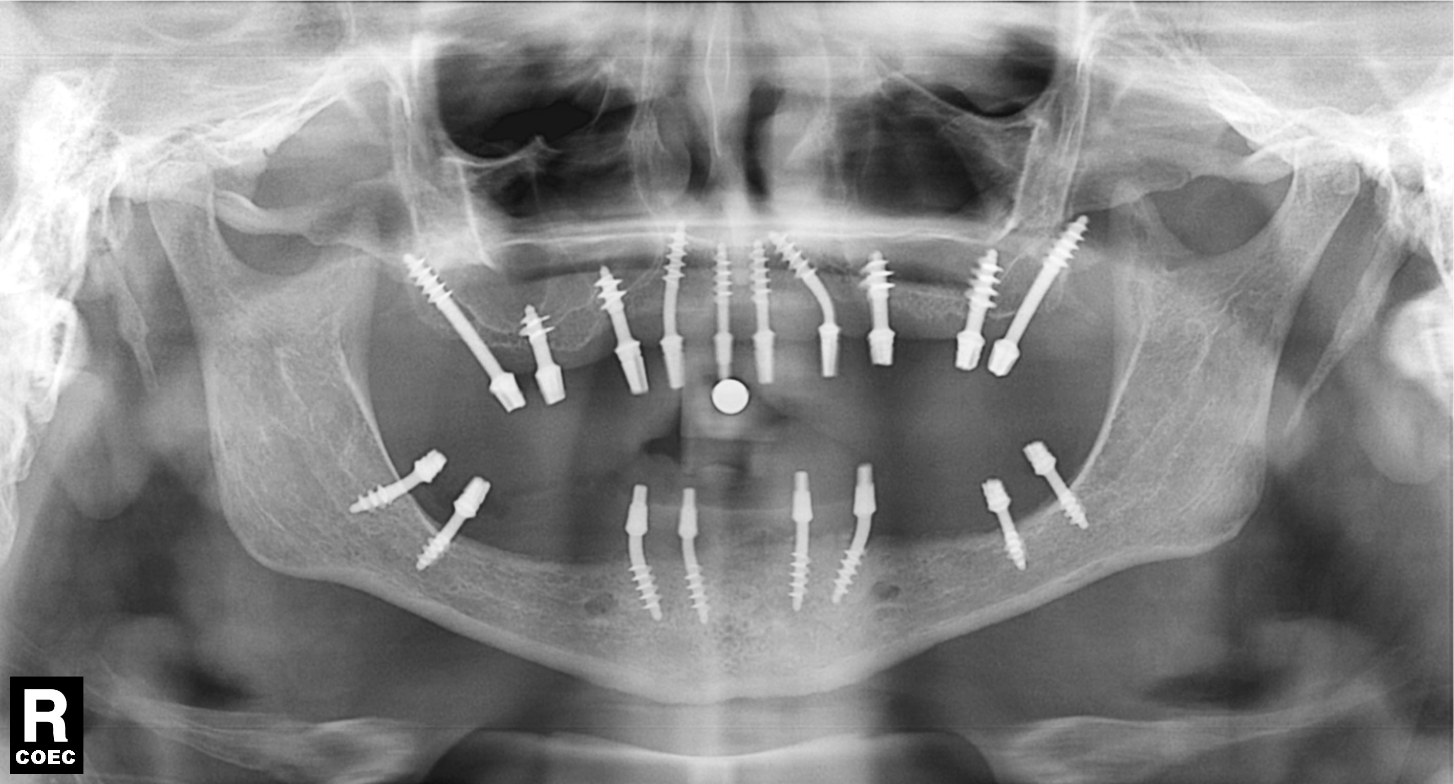 Survival Rate of Immediately Loaded Implants Restored using the Intraoral Welding Technique: A Literature Review