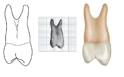 Endodontic Management of Ridiculous Maxillary Premolar: A Case Report