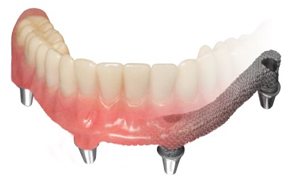 Accidental Ingestion of Dental Prosthesis: A Propos of 14 Cases