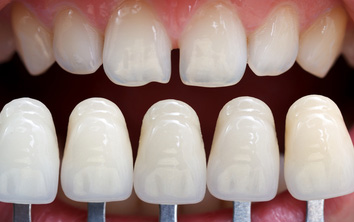 Masking Potential of Ceramic Veneers in Thin Sections: Effect of Ceramic Type, Ceramic Thickness, Background Color and Framework Addition