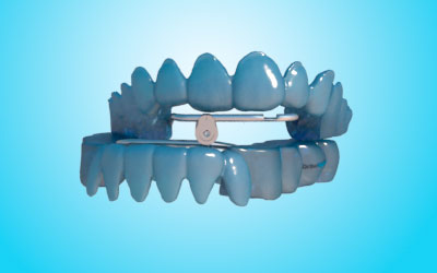 Confection of an Occlusal Stability Intra-Oral Device for Violin Players