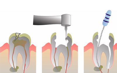 Halitosis: Its Intraoral Factors and Mechanism Relating to Formation