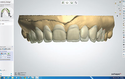 Comparison between Interdental Brush and Dental Floss for Controlling Interproximal Biofilm in Teeth and Implants