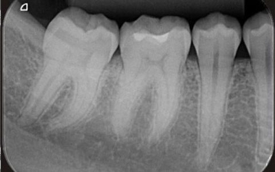 History of Digital Detectors in Intraoral Radiography