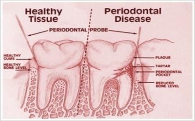 Herpes Simplex Virus 1 and 2 in Chronic Periodontitis: Prevalence and Association with Clinical Parameters