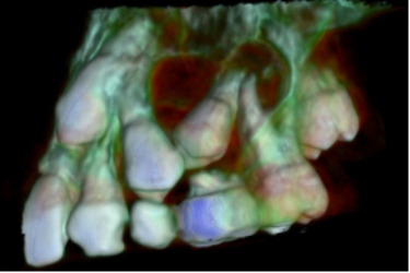 Cystic Lesion on an Upper Premolar Related to Pulpotomized Deciduous Molar: A Case Report