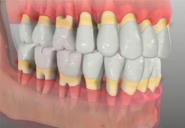 The Inter-Relationship between Periodontal Disease and Diabetes Mellitus: A Review and Four Case Reports