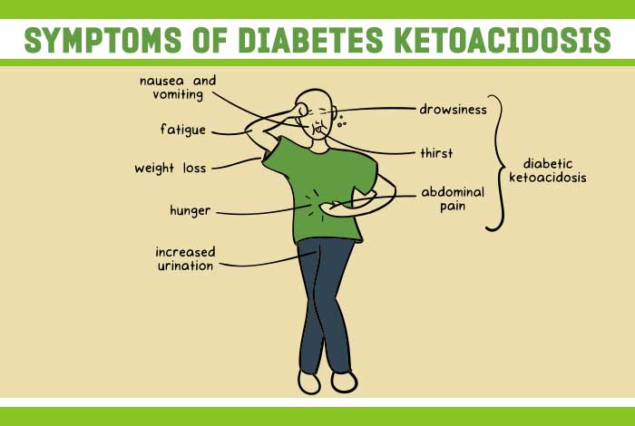 Euglycemic Diabetic Ketoacidosis in a Patient with SARS-COV-2 Infection, a Stress Induced Complication or a Coronavirus Related Complication?