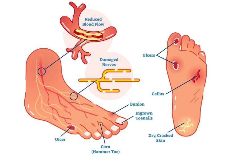 Diabetic Foot Profile in Patients under General Hemodialysis