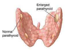 Multiple Giant Brown Tumors in a Patient with Secondary Hyperparathyroidism: A Case Report on Successful Treatment after Total Parathyroidectomy and Autotransplantation