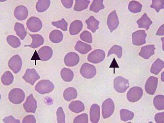 A Case Report of Diabetic Ketoacidosis Associated with Multiple Risk Factors Including Dapagliflozin Use