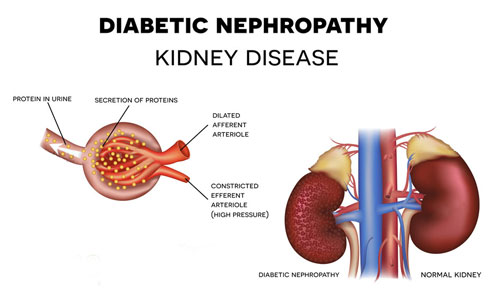 The Importance of Gene X Environment Interactions in Diabetic Nephropathy