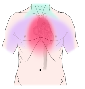 Effect of PCI on Cardiac Function in Chronic Stable Angina Patients with â€œNormalâ€ Ejection Fraction: A Tissue Doppler Study