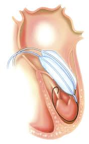 Predictors of Complications During Percutaneous Multitrack Balloon Mitral Valvuloplasty