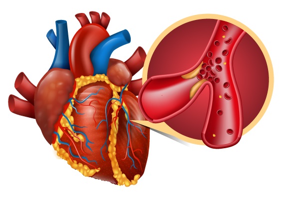 Two Dimensional Speckle Tracking Echocardiography Assessment of Left Ventricular Remodeling in Patients after Myocardial Infarction