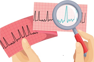 Does Oral Anticoagulation Therapy Reduce Thromboembolic Events or Mortality In Patients with Device-detected Subclinical Atrial Fibrillation? A Review