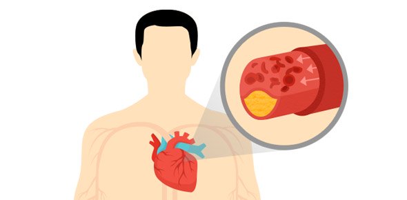 Factors Affecting Outcome of Rescue Percutaneous Coronary Intervention in Acute Myocardial Infarction