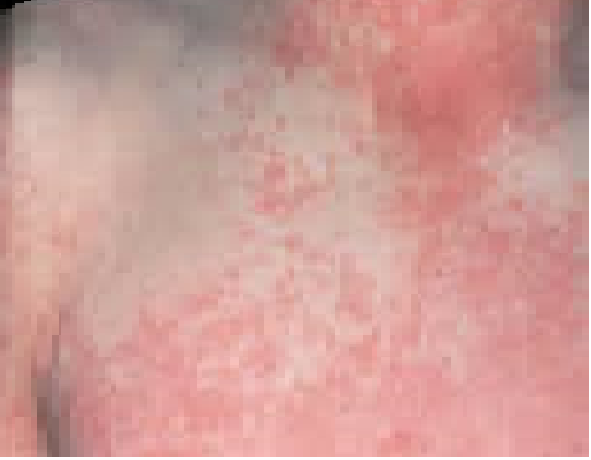 Acute Rheumatic Fever Presenting With Severe Epistaxis in A Child in Sokoto, Nigeria