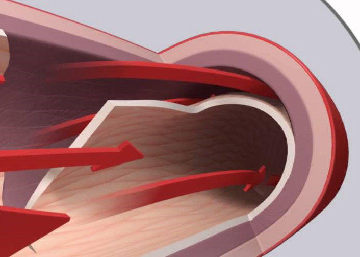 Spot Stenting of Spontaneous Coronary Artery Dissection in a Patient Presenting with Anterior Wall ST Elevation Myocardial Infarction