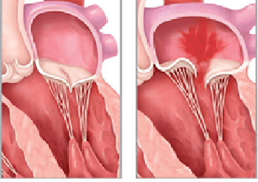 Papillary Muscle Noncompaction: A Unique Mechanism for Mitral Regurgitation in Children