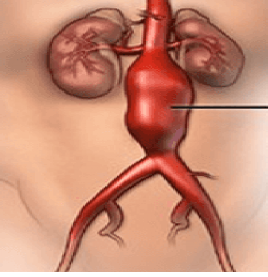 Bronchial artery Aneurysm Diagnosis and Treatment