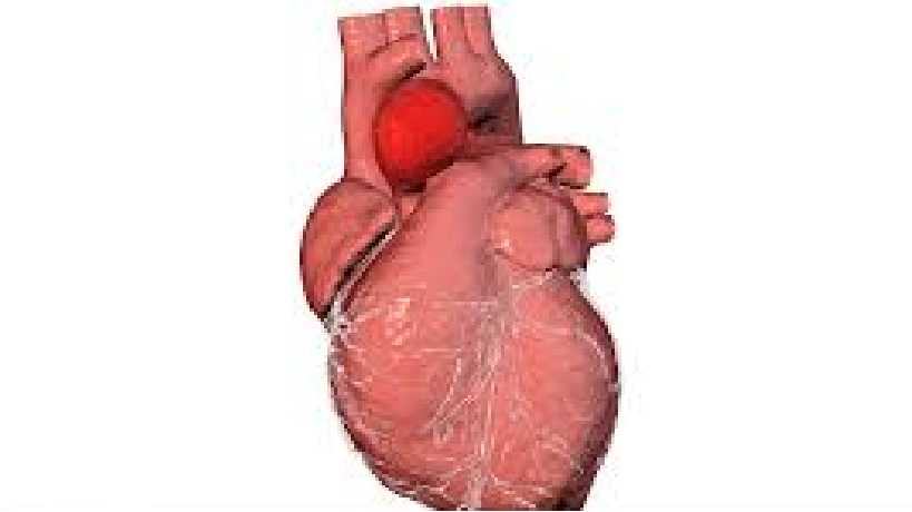 An Experience of Performing Device Closure in Two Cases of Rupture of Sinus of Valsalva Aneurysm during the COVID-19 Pandemic