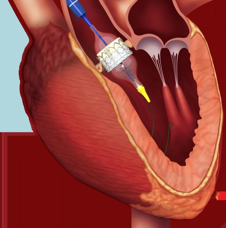 Conscious Sedation with Local Anesthesia Versus General Anesthesia for Patients Undergoing Transcatheter Aortic Valve Implantation: A Randomized Controlled Trial