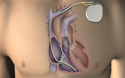 Role of an Implantable Cardioverter Defibrillator in Emery Dreifuss Muscular Dystrophy: A Case Report and a Review of the Literature