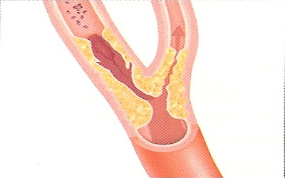 Carotid Plaque and MMP-9 Controversies