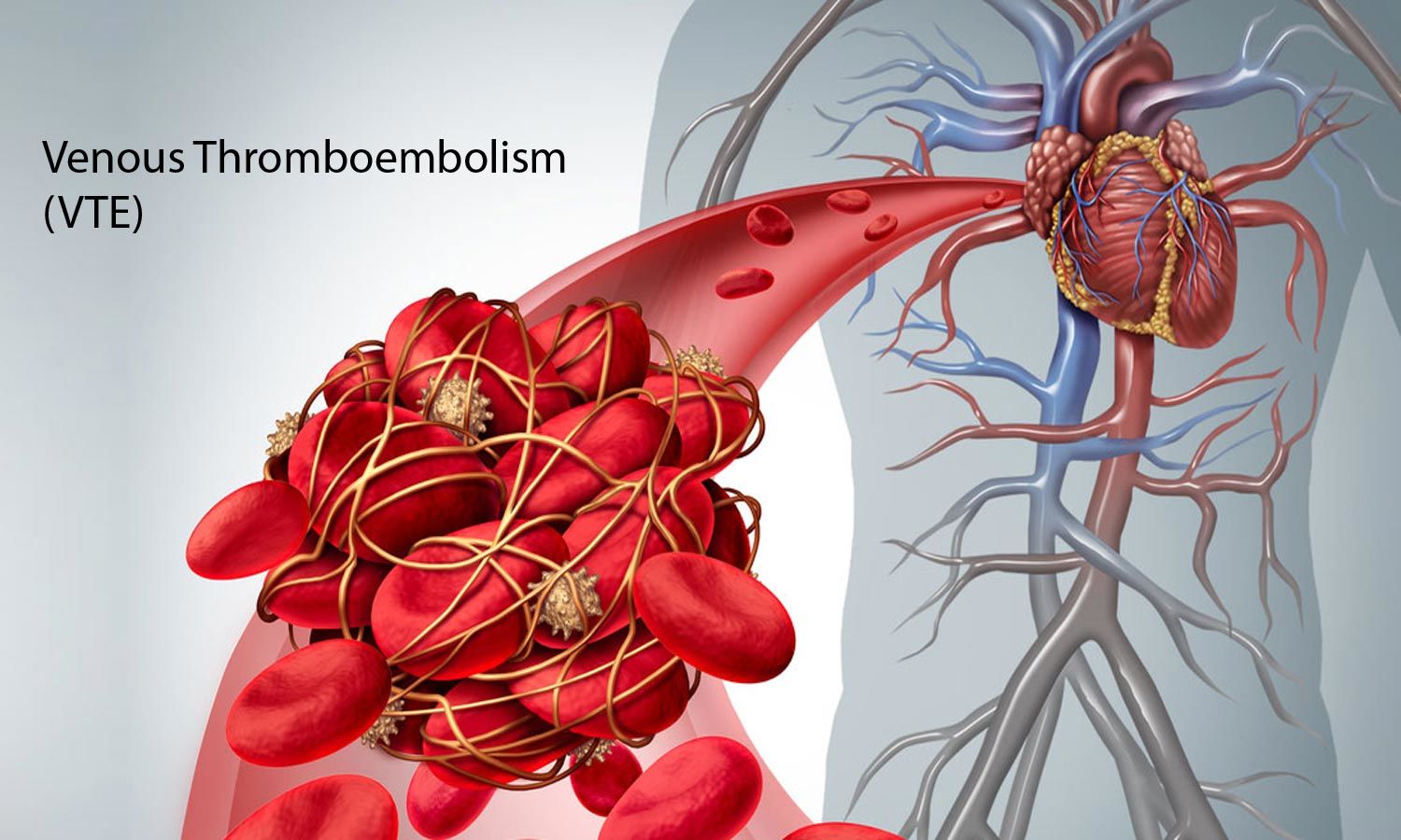 Thrombotic Complications in SARS CoV-2 IgG Positive Patients with Asymptomatic COVID-19 Infection