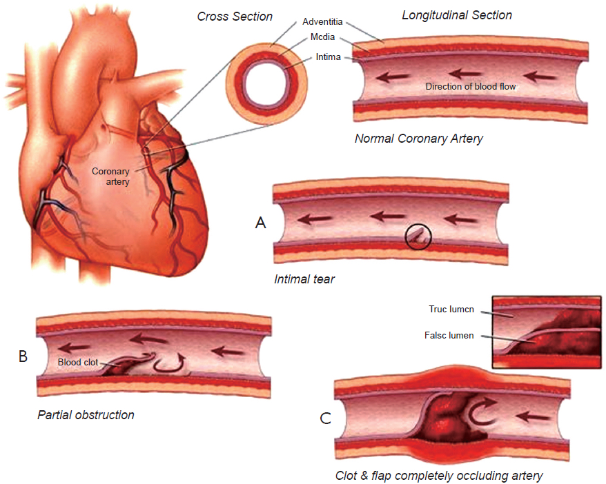 Atherosclerotic Burden of Cronaries in DM with MSCT