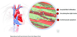 Chemotherapy or not? Sudden Death of Primary Cardiac Amyloidosis after Chemotherapy: A Case Report