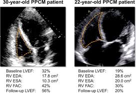 Peculiarity of Peripartum Cardiomyopathy (PPCM)