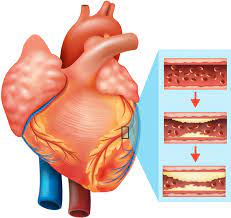 Effects of Cardiovascular Diseases in Men and Women