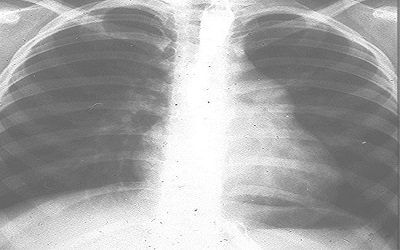 Anesthetic Approach of Two Parturient with Eisenmenger Syndrome (Case Report)