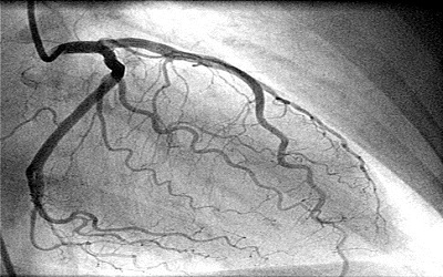 Fractional Flow Reserve in Contemporary Clinical Practice