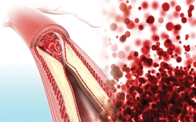 LDL Lowering: Evidence for a Plaque Non-Progression Threshold