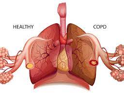 Chronic Obstructive Pulmonary
Disease (COPD)