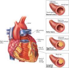 Complications of
Hypercholesteremia and
Hardening of the Arteries