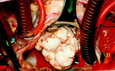 Right Atrial Fungal Mass Mimicking Cardiac Myxoma in an Immunocompetent Patient-A Case Report