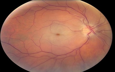 Impact of Severe Mitral Stenosis on Visual Acuity, Intraocular Pressure, and Retinal Arteries