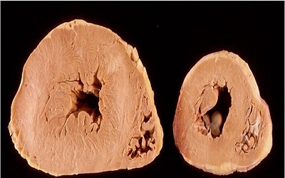 ACP1 Genetic Polymorphism and Cardiac Hypertrophy