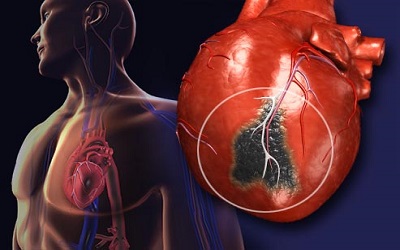 Ischemia-Modified Albumin as a Marker of Myocardium and Skeletal Muscle Damage