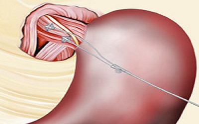 A Case of Syncope Induced by Dining-Related Esophageal Stimulation