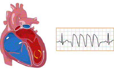 Pharmacological and Non- Pharmacological Therapies of Catecholaminergic Polymorphic Ventricular Tachycardia