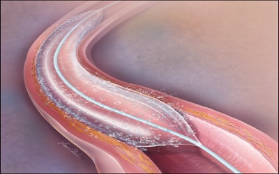 Use of Strain Imaging to Predict Myocardial Function Recovery after Percutaneous Revascularization of Infarct Related Artery