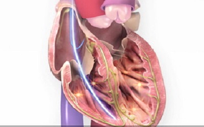 Electrocautery Induced Ventricular Fibrillation in a Cardiac Surgical Patient on Temporary Pacemaker: Case Report