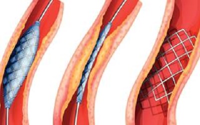 Acute Severe Ischemia Following Protected Distal Left Main Stenting for Recurrent Drug-Eluting Instent Restenosis: A Potential New Mechanism for
Side-Branch Ischemia