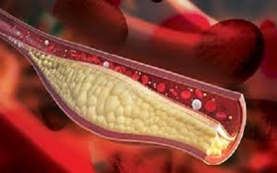 Demonstration of Early Endothelial Dysfunction in Diabetics with Normal Exercise Electrocardiogram